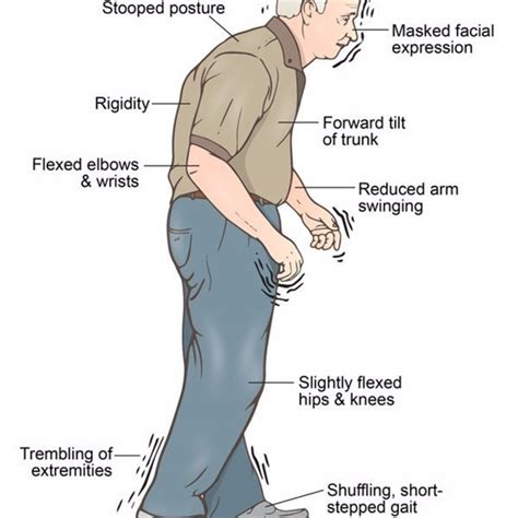 gait of parkinson patient